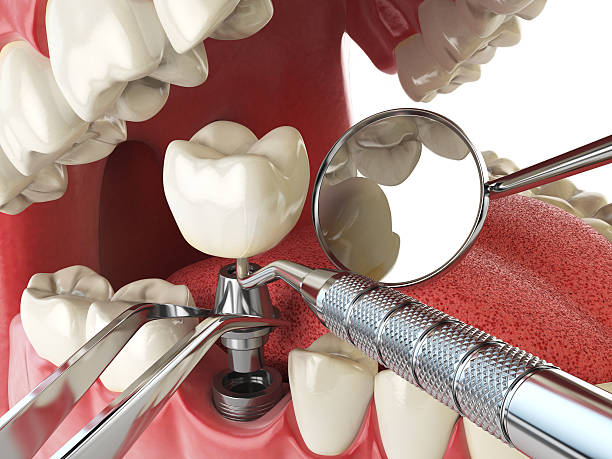 Best Emergency Broken Tooth Repair in South Berwick, ME